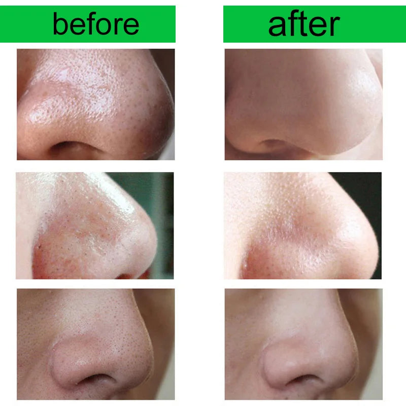 Crème anti- points noirs pour le visage