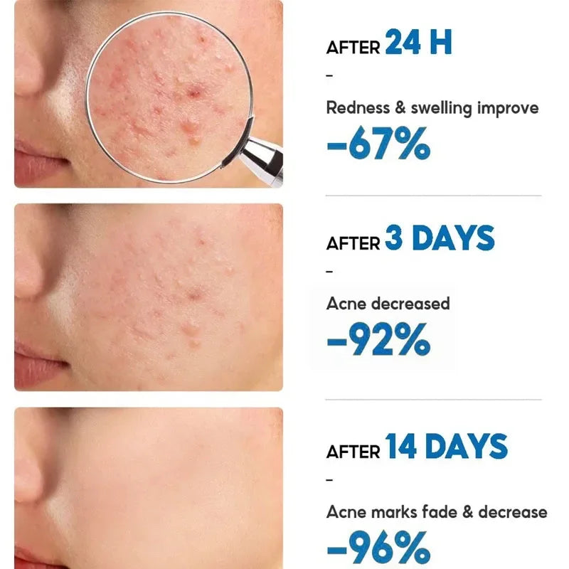 Crème Anti-Acné à l'Acide Salicylique Réparation Anti-Acné Rougeurs Boutons Nettoyage Profond des Pores Contrôle du Sébum Hydratation Soin de la Peau