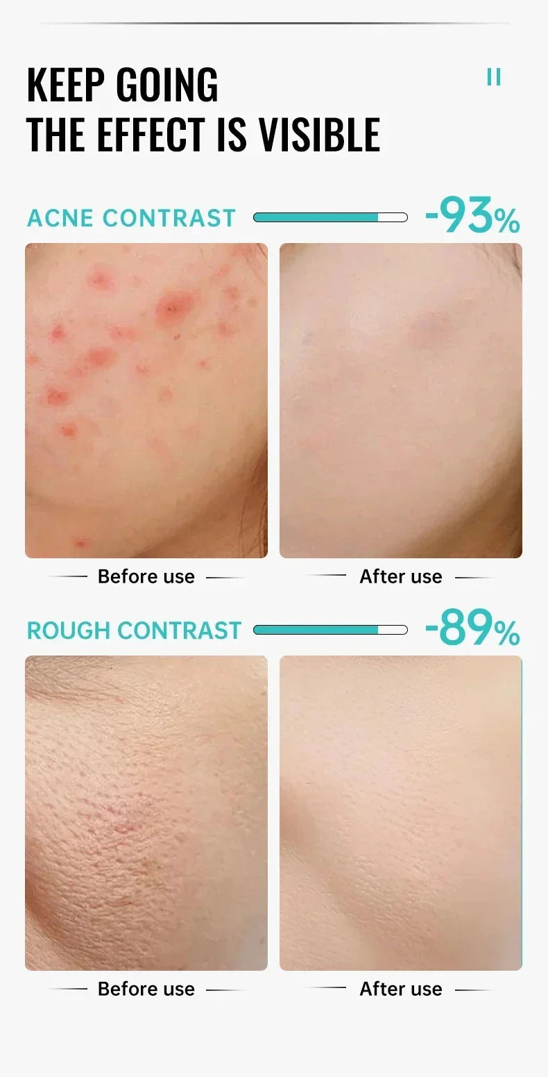 Crème Anti-Acné à l'Acide Salicylique Réparation Anti-Acné Rougeurs Boutons Nettoyage Profond des Pores Contrôle du Sébum Hydratation Soin de la Peau