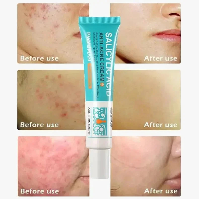 Crème Anti-Acné à l'Acide Salicylique Réparation Anti-Acné Rougeurs Boutons Nettoyage Profond des Pores Contrôle du Sébum Hydratation Soin de la Peau