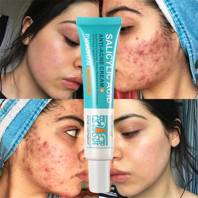 Crème Anti-Acné à l'Acide Salicylique Réparation Anti-Acné Rougeurs Boutons Nettoyage Profond des Pores Contrôle du Sébum Hydratation Soin de la Peau