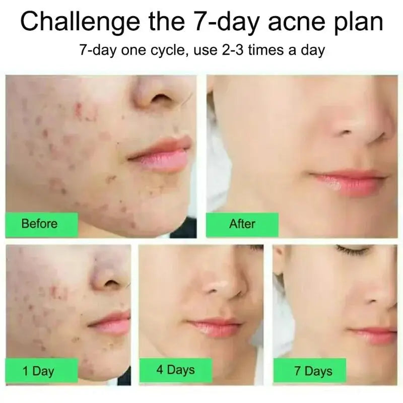 Crème Anti-Acné à l'Acide Salicylique Réparation Anti-Acné Rougeurs Boutons Nettoyage Profond des Pores Contrôle du Sébum Hydratation Soin de la Peau