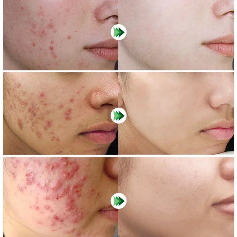 Crème Anti-Acné à l'Acide Salicylique Réparation Anti-Acné Rougeurs Boutons Nettoyage Profond des Pores Contrôle du Sébum Hydratation Soin de la Peau