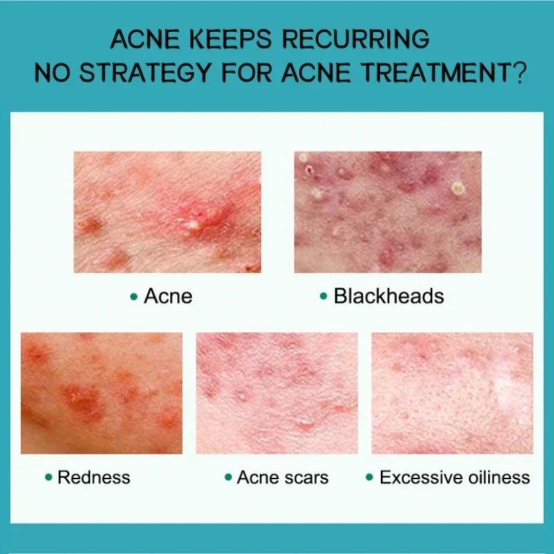 Crème Anti-Acné à l'Acide Salicylique Réparation Anti-Acné Rougeurs Boutons Nettoyage Profond des Pores Contrôle du Sébum Hydratation Soin de la Peau