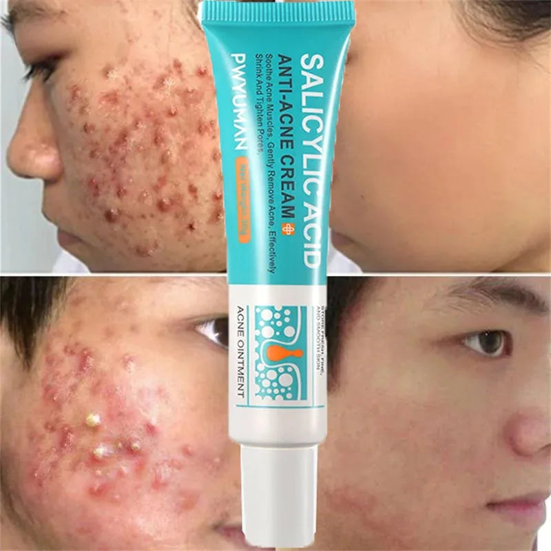 Crème Anti-Acné à l'Acide Salicylique Réparation Anti-Acné Rougeurs Boutons Nettoyage Profond des Pores Contrôle du Sébum Hydratation Soin de la Peau