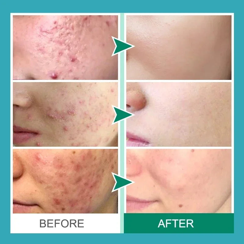 Crème Anti-Acné à l'Acide Salicylique Réparation Anti-Acné Rougeurs Boutons Nettoyage Profond des Pores Contrôle du Sébum Hydratation Soin de la Peau